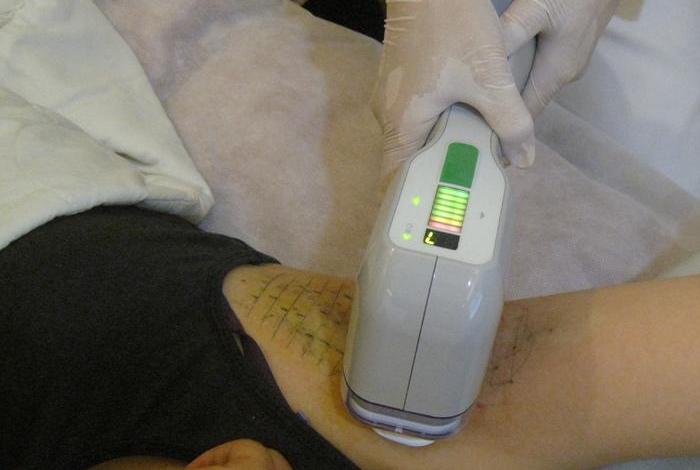 MiraDry腋下多汗治療