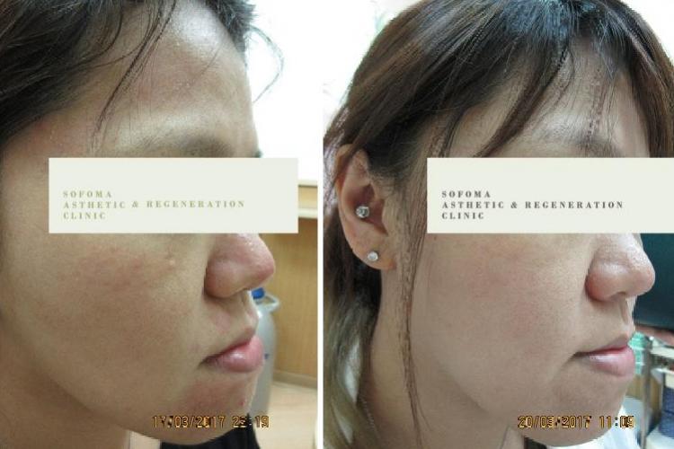 美國皮秒PICOQ雷射