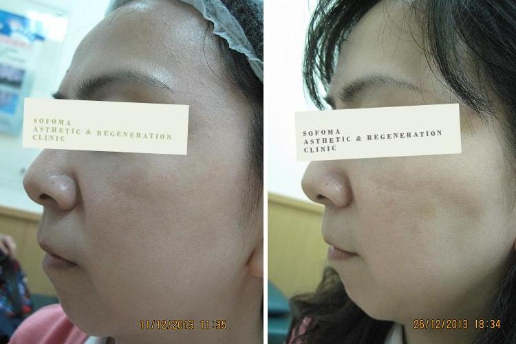 美國皮秒PICOQ雷射