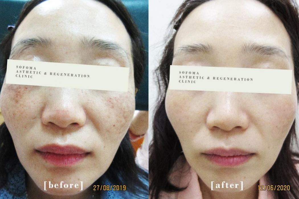 美國皮秒PICOQ雷射